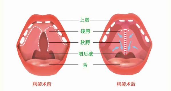 腭裂手術